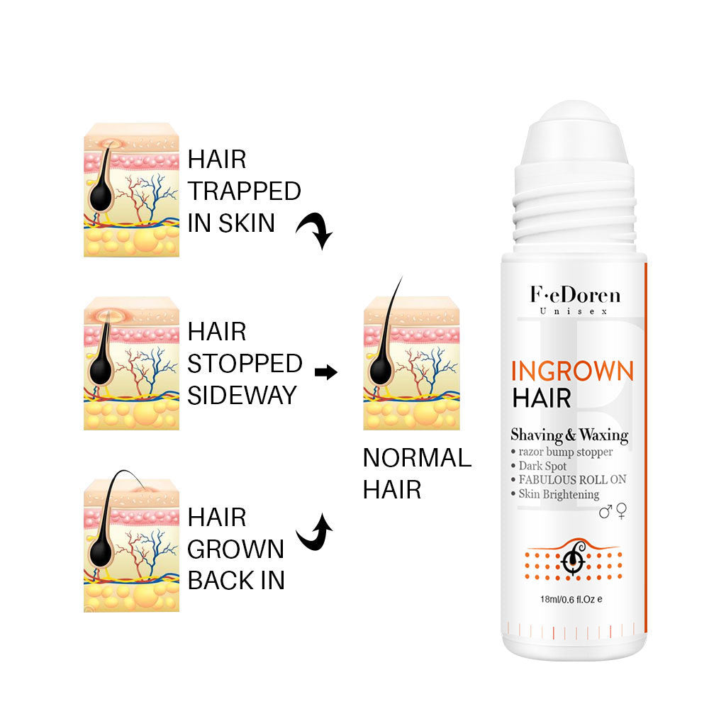 Conveniently Apply Roller Hair In-growth For Men